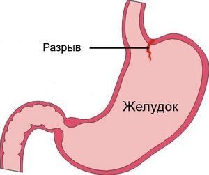 Симптомы и последствия обжигания пищевода горячей пищей