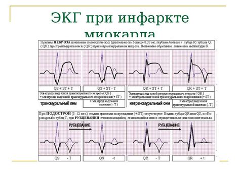 Симптомы и признаки С-типа ЭКГ