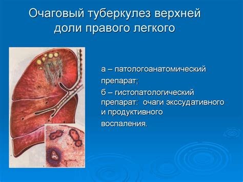 Симптомы и признаки инфратенториальных очагов