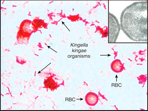 Симптомы и признаки повышения концентрации Kingella spp в крови