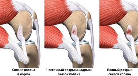 Симптомы и признаки подвывиха колена