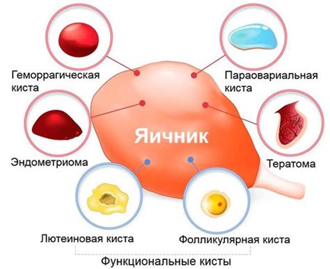 Симптомы кровотока в кисте яичника