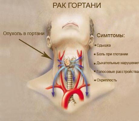 Симптомы лопнувшего сосуда в горле