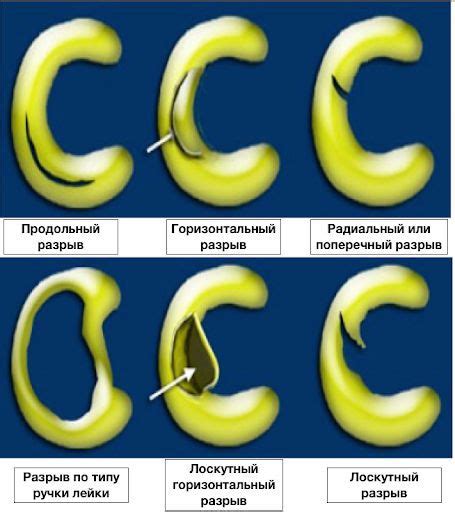 Симптомы мениска 3а степени