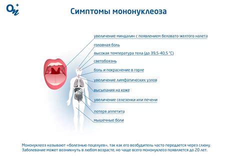 Симптомы мононуклеоза у детей