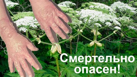 Симптомы отравления борщевиком