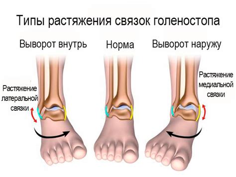 Симптомы растяжения связок на ноге