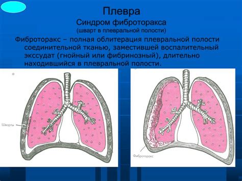 Симптомы спайки на легком