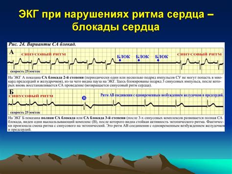 Симптомы эктопического предсердного ритма у ребенка