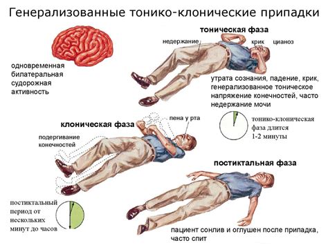 Симптомы эпилепсии: как определить наличие заболевания?