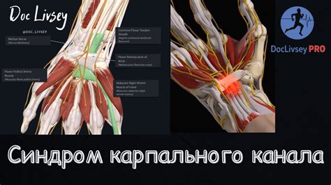 Синдром карпального тоннеля