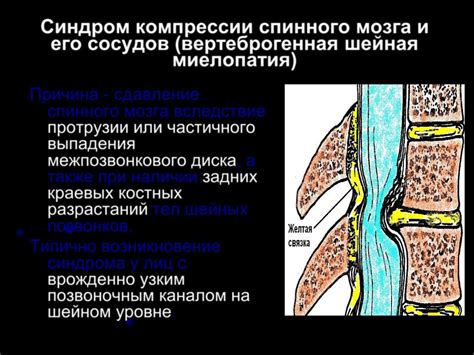 Синдром компрессии нерва