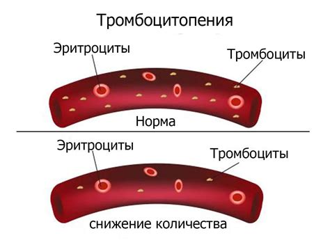 Слабые сосуды и тромбоцитопения