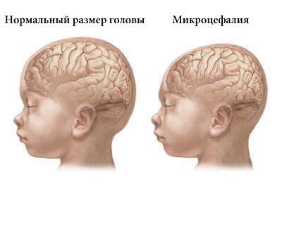 Следствия микроцефалии для здоровья