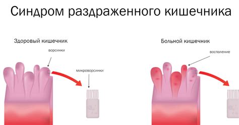 Снятие симптомов синдрома раздраженного кишечника