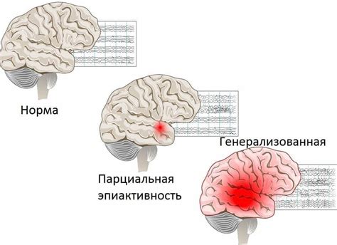 Специфика эпилептической активности мозга