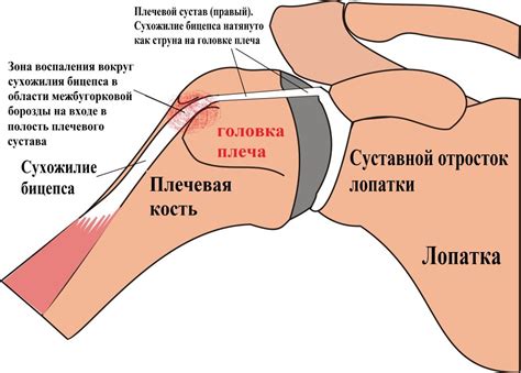 Сравнение растяжки сухожилия в плечевом суставе с другими повреждениями