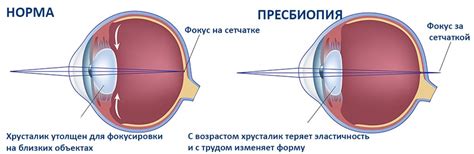 Старческая дальнозоркость