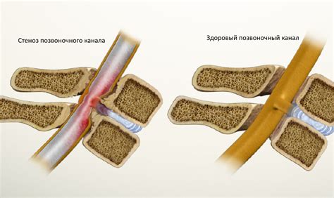 Стеноз позвоночного канала