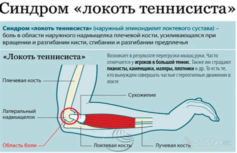 Теннисный локоть (эпикондилит)