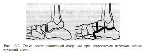 Травмы и переломы костей ног