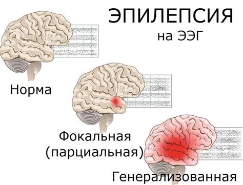 Увеличение частоты эпилептических приступов