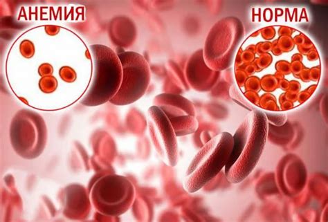 Употребление алкоголя и железодефицитная анемия