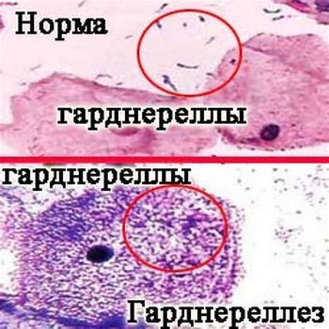 Уреаплазма у женщин: причины, симптомы и диагностика