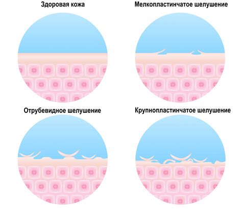 Устранение сухости и шелушения кожи