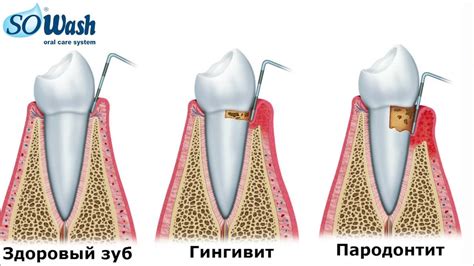 Уход за коронками