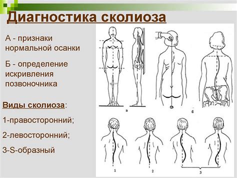 Физические упражнения для коррекции перекоса позвоночника вправо