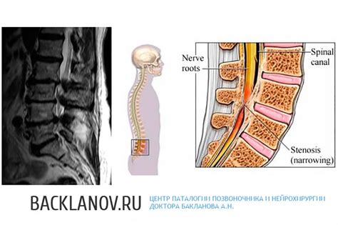 Функции дурального мешка в поясничном отделе