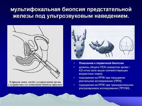 Хирургическая капсула предстательной железы: что это такое?