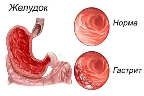 Хронический гастрит