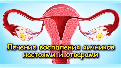 Что вызывает воспаление яичников?