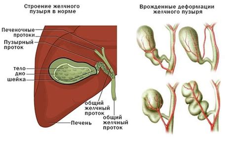 Что избегать при деформации желчного пузыря