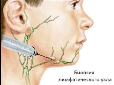 Что может привести к воспалению лимфоузла на руке?