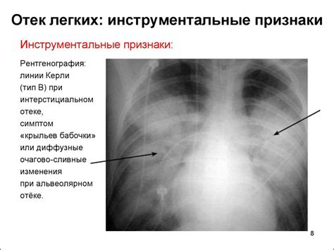 Что не видно на рентгенограмме гортани