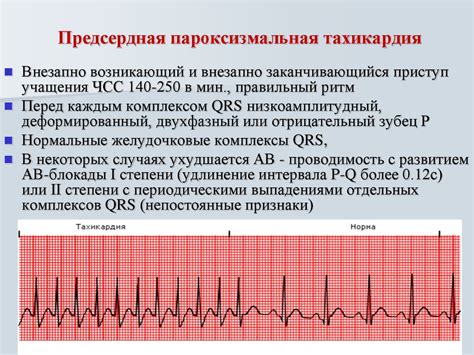 Что такое НРС по типу пароксизмальной тахикардии?