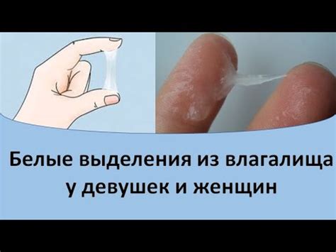 Что такое белые выделения из влагалища?