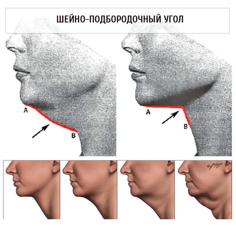 Что такое второй подбородок и как он возникает?