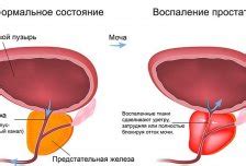 Что такое гиперплазия в прямой кишке?