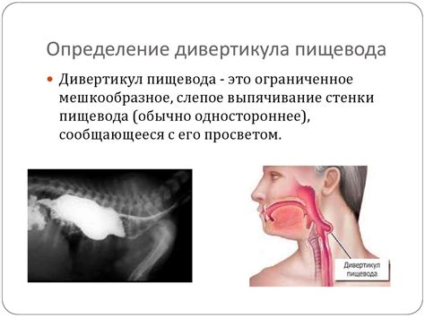 Что такое дивертикул пищевода