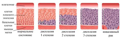 Что такое интраэпителиальная неоплазия высокой степени