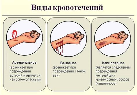 Что такое капиллярное кровотечение и как его определить?