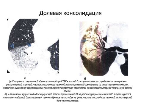 Что такое консолидация легочной ткани?