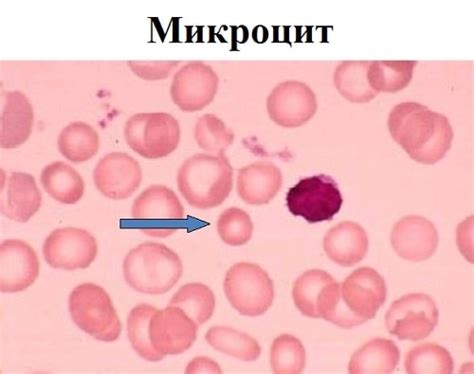Что такое микроциты и почему они появляются?