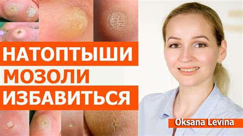 Что такое мозоли и как они образуются