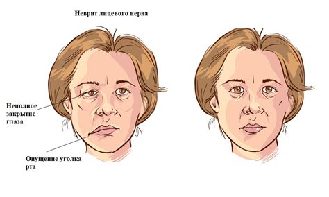 Что такое неврит и как он отличается от невралгии и полинейропатии