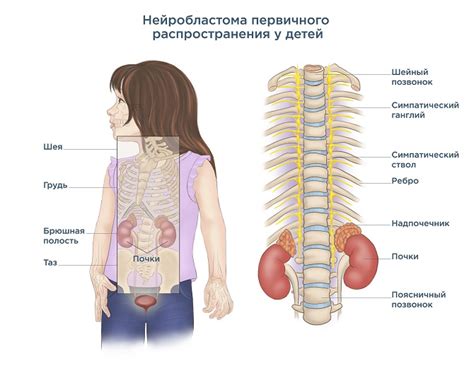 Что такое низкодифференцированная нейробластома с низким МКИ?